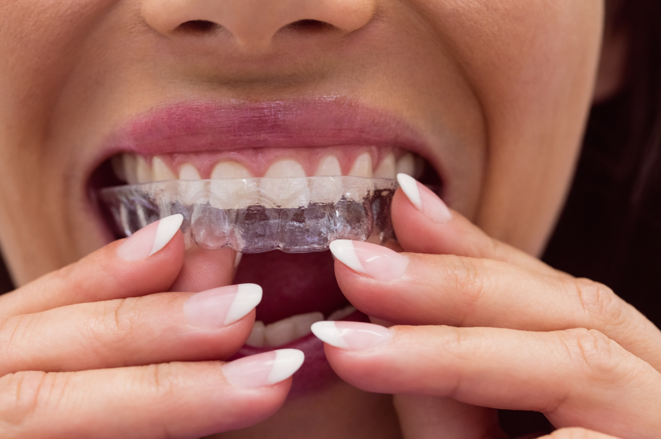 Clear Alternative To Adult Braces Lampros Reopelle Orthodontics