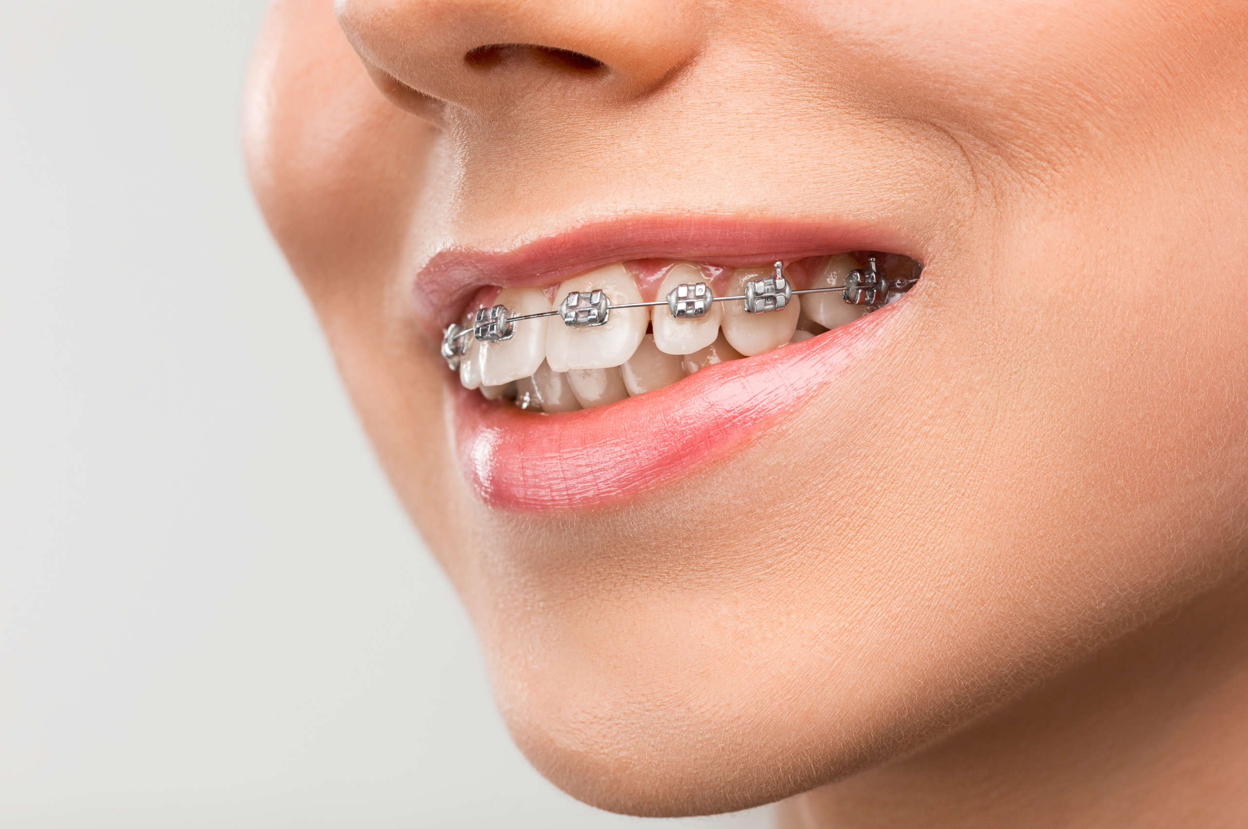 How Do Braces Work? - Reopelle Orthodontics