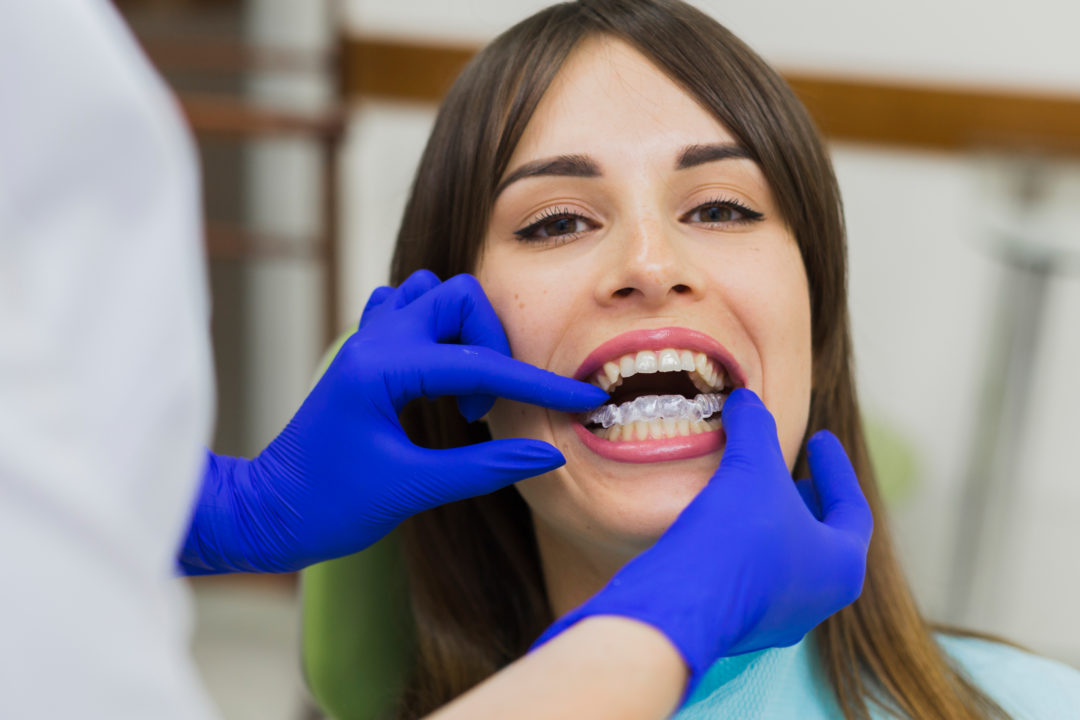 Invisalign Teen