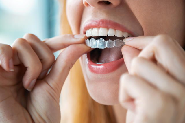 Invisalign Braces In Roanoke Lampros Reopelle