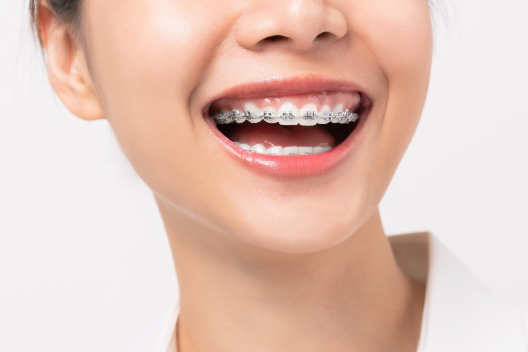 Dental braces help perfect your smile