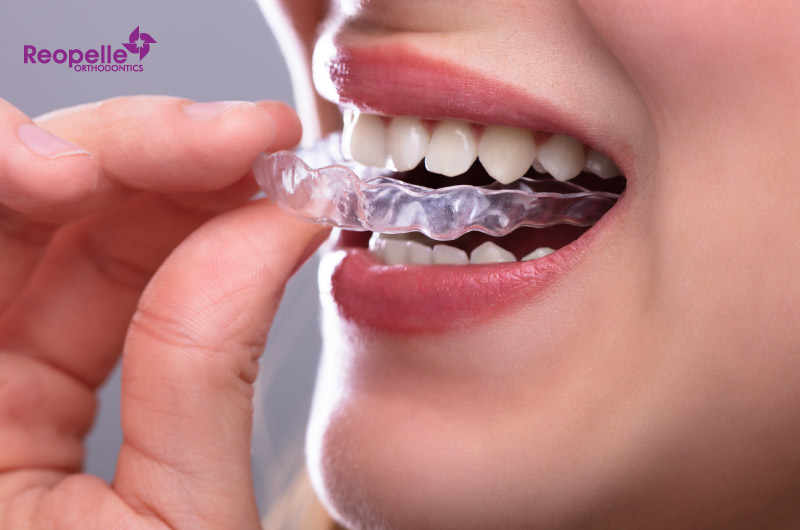 Why Is Invisalign Worth It As An Adult?