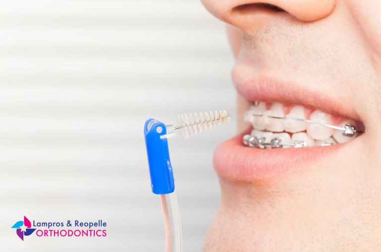 How to Clean My Teeth While Wearing Braces? Reopelle Orthodontics