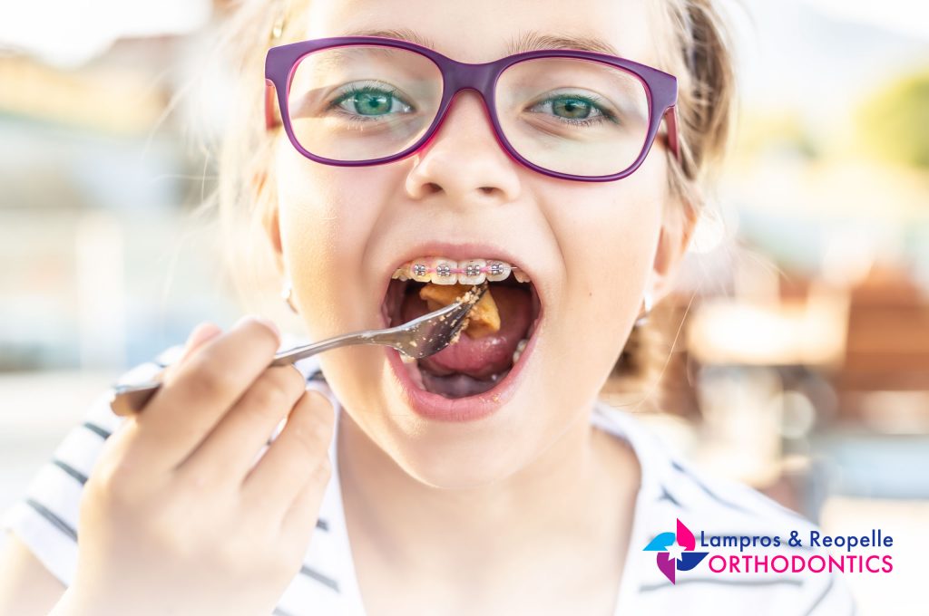 What Can I Eat With Braces? Reopelle Orthodontics