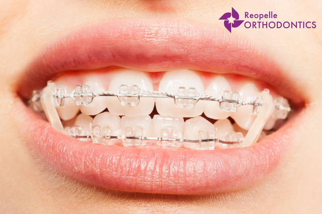 Rubber bands can help your treatment with braces move faster.