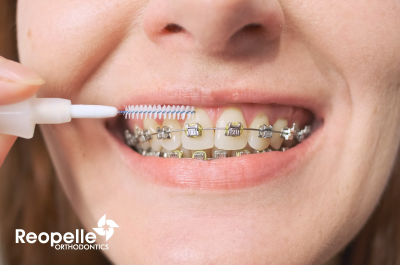 10 Keys for Effective Dental Care and Oral Hygiene With Braces and Retainers